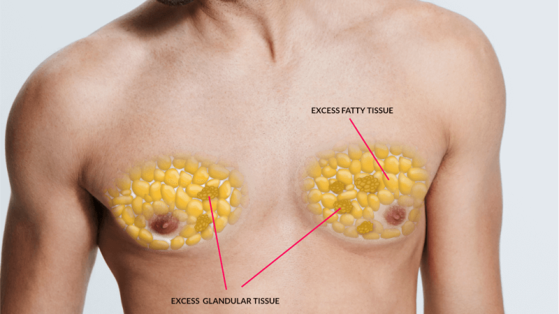 5a321ac2fd7b9d00016be824_gynecomastia 5a321ac2fd7b9d00016be824_gynecomastia
