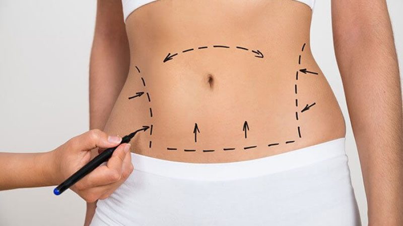 Liposuction-Surgery Liposuction-Surgery