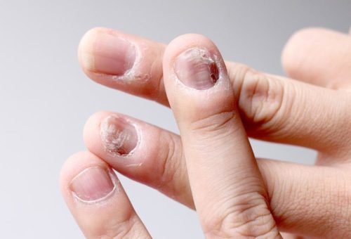 Nail-Diseases-1024×597 Nail-Diseases-1024x597