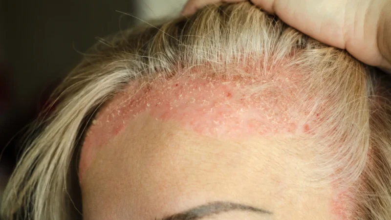 Scalp-Psoriasis-Symptoms-Treatments Scalp-Psoriasis-Symptoms-Treatments