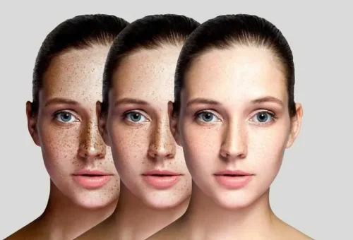 Skin-Pigmentation-1024×576 Skin-Pigmentation-1024x576