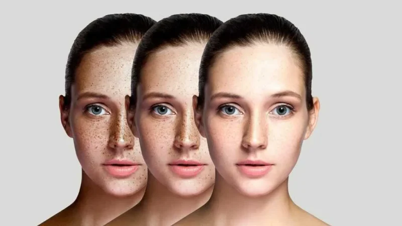 Skin-Pigmentation-1024×576 Skin-Pigmentation-1024x576