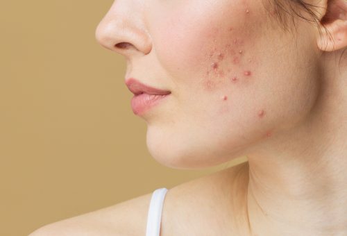 Young woman before and after acne treatment. Skin care concept Young woman before and after acne treatment. Skin care concept