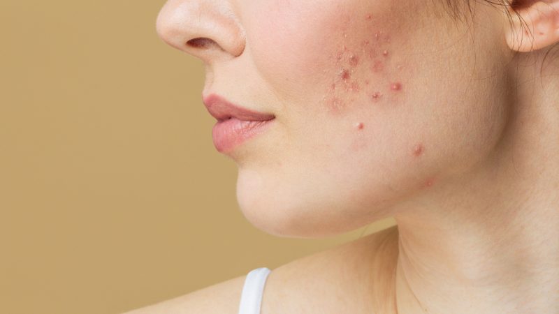 Young woman before and after acne treatment. Skin care concept Young woman before and after acne treatment. Skin care concept