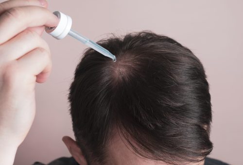 Hair loss problem. Man applying dropper with minoxidil or serum. Hair loss problem. Man applying dropper with minoxidil or serum.