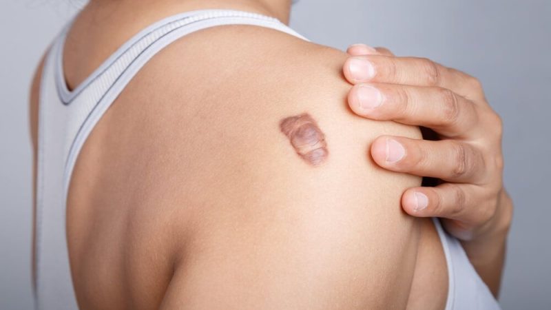 keloid-scars_440378110.jpg.optimal keloid-scars_440378110.jpg.optimal