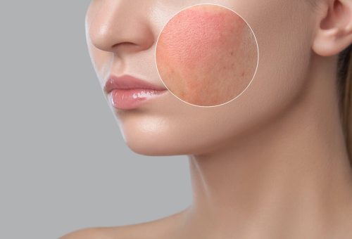 skin-inflammation skin-inflammation