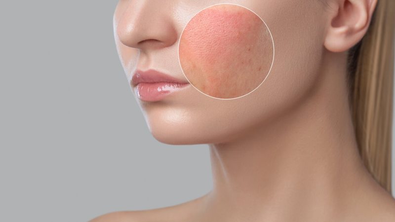 skin-inflammation skin-inflammation